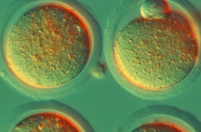 Hope for HIV Patients: The Potential of Stem Cell Transplantation