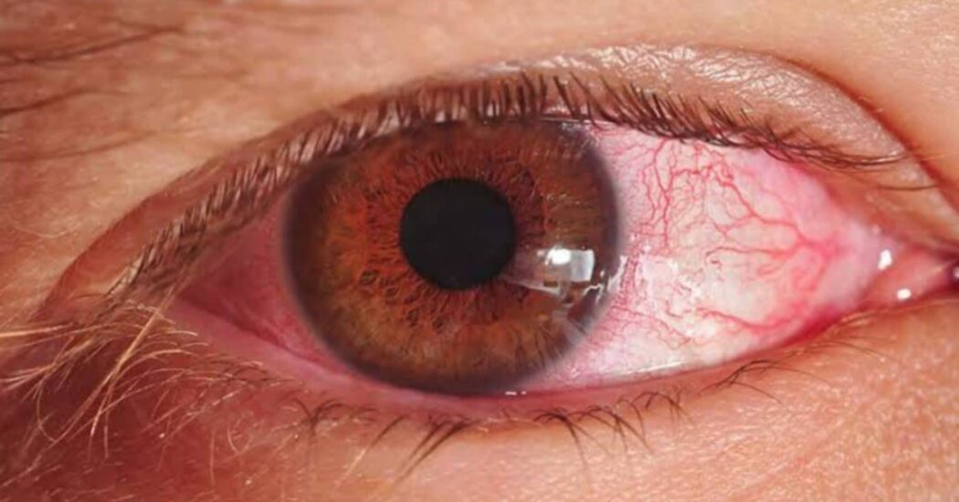 Sindh Health Authorities Issue Guidelines to Combat Pink Eye Spread