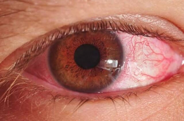 Sindh Health Authorities Issue Guidelines to Combat Pink Eye Spread