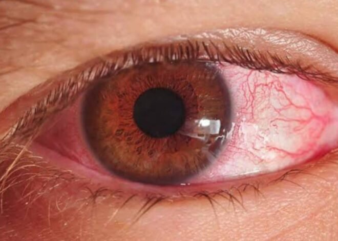 Sindh Health Authorities Issue Guidelines to Combat Pink Eye Spread