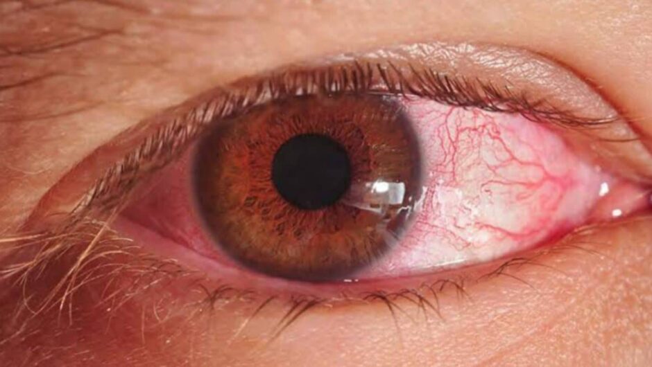 Sindh Health Authorities Issue Guidelines to Combat Pink Eye Spread