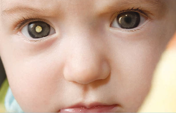 Pediatric eye cancer rapidly spreads in Pakistani children