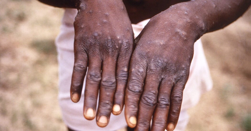 Africa Faces Nearly 30,000 Suspected Mpox Cases as Outbreak Spreads