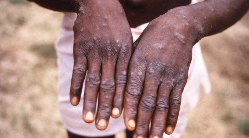 Africa Faces Nearly 30,000 Suspected Mpox Cases as Outbreak Spreads