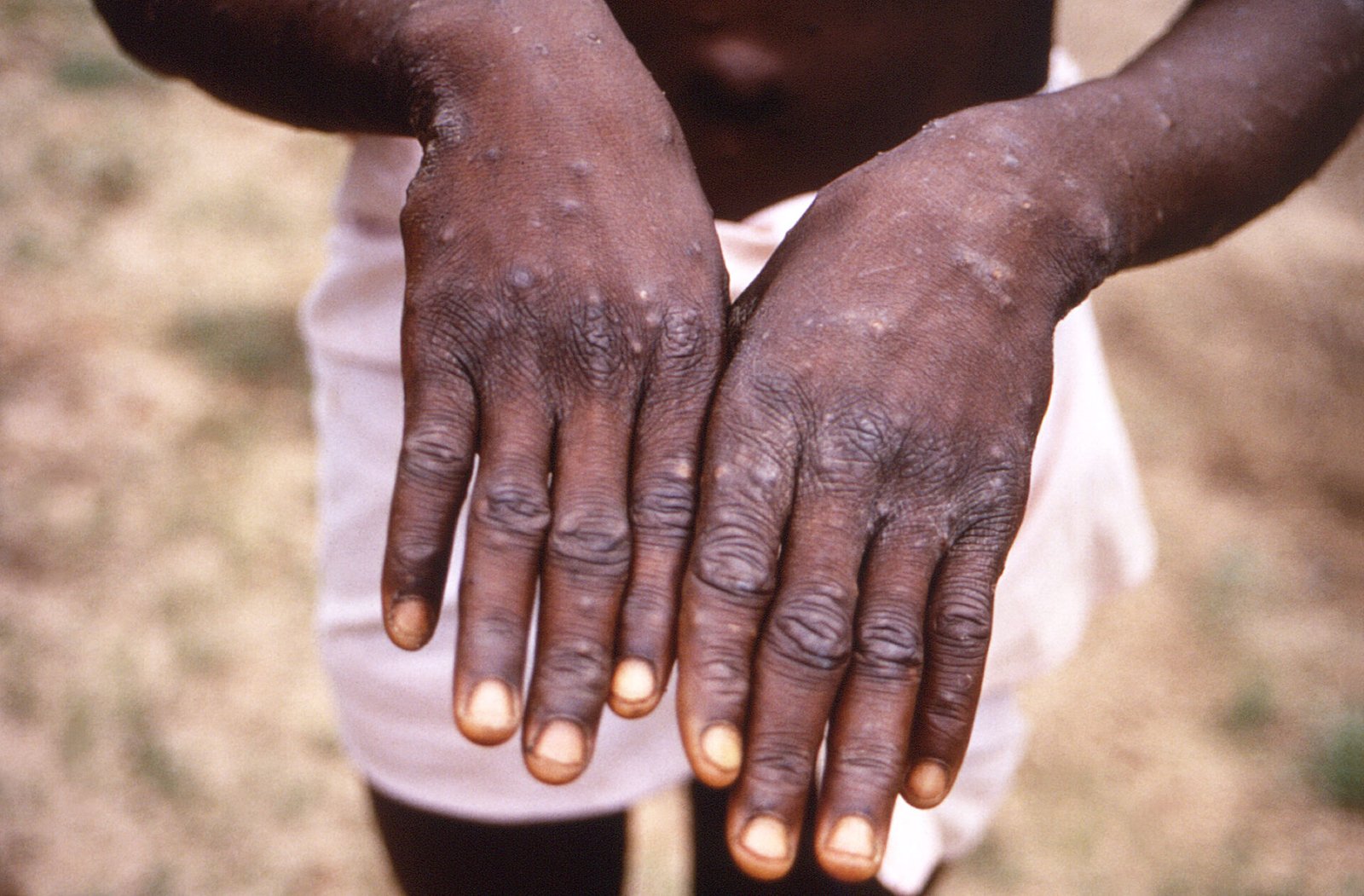 Africa Faces Nearly 30,000 Suspected Mpox Cases as Outbreak Spreads