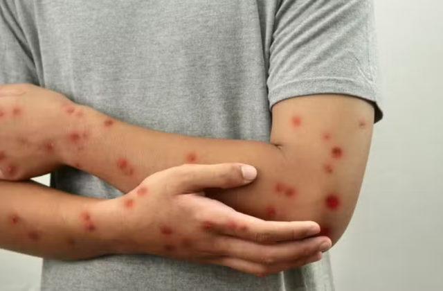 Mpox Cases in Pakistan Raise Concerns Over Possible Local Transmission